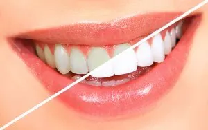 How Long Will My Teeth Whitening Results Last?